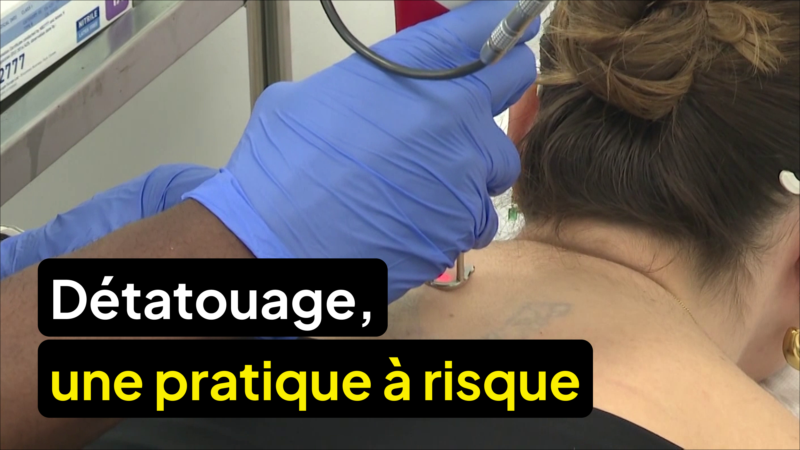 Le détatouage, une pratique à risque